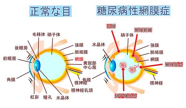 糖尿病網膜症イメージ図