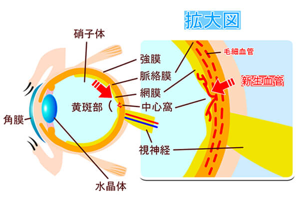 加齢黄斑変性イメージ