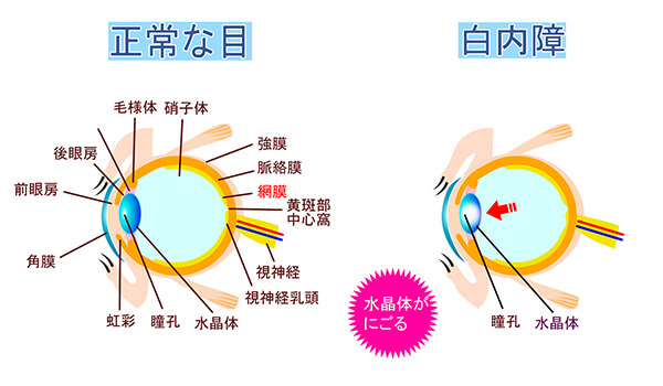 白内障イメージ図